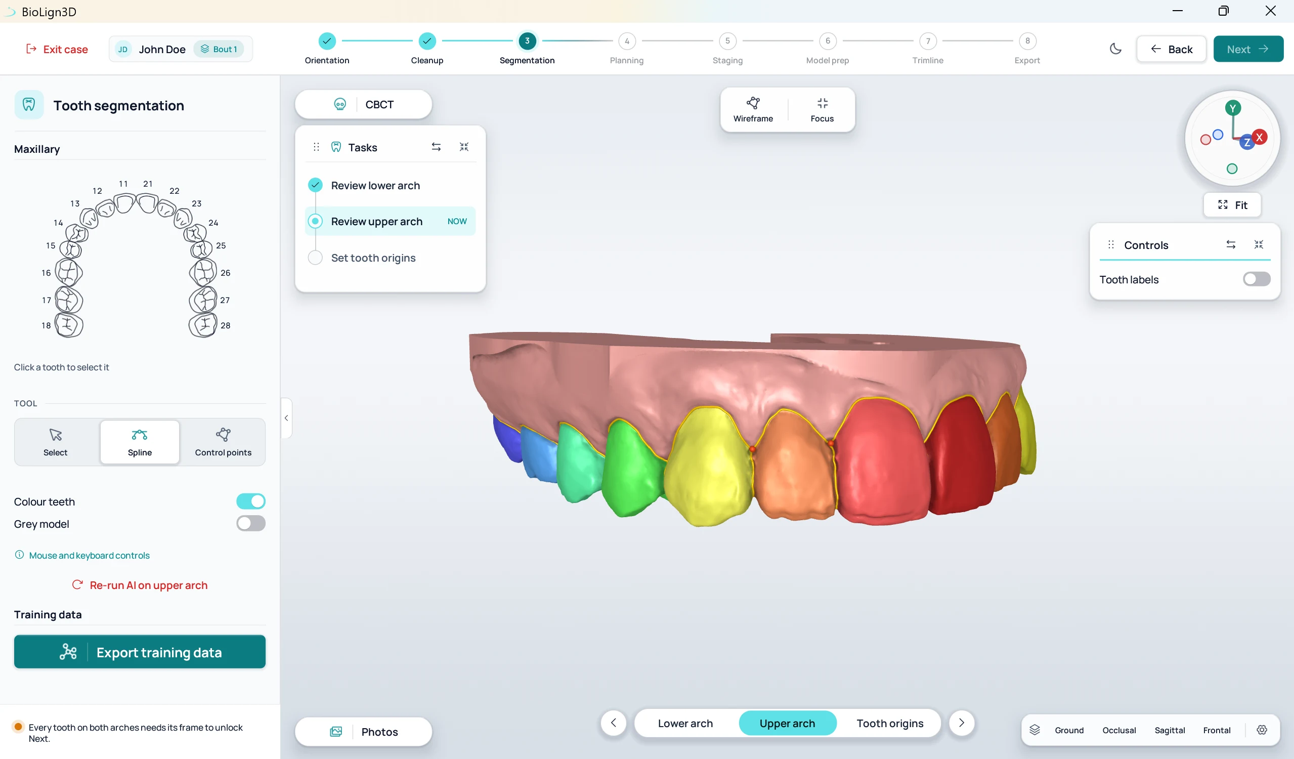 BioLign3D tooth segmentation of the upper arch, each tooth coloured and numbered